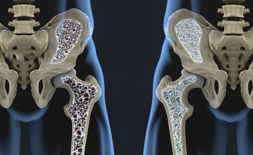 3D Illustration Of Bone Structure - Normal & Having Osteoporosis.